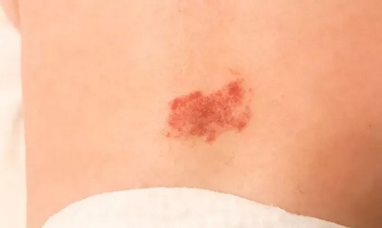 "胎记"也分好坏？长这样的可能恶变，一定要注意！