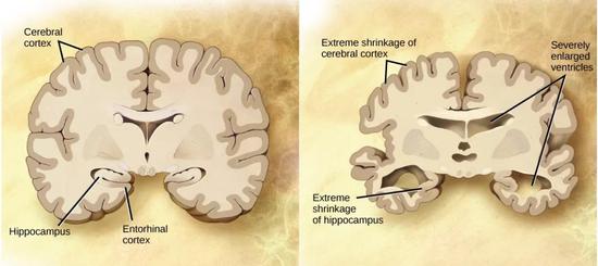 ▲阿兹海默病患者的大脑（右）会出现明显萎缩（图片来源：CNX OpenStax [CC BY 4.0 （https：//creativecommons.org/licenses/by/4.0）]， via Wikimedia Commons）