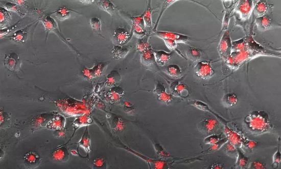 显微镜下捕获的自毁性脑肿瘤细胞。这种红色染色来自于细胞“自噬”过程的标记物。来源： Stem Cells and Brain Tumour Group， University of Leeds