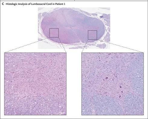 患者1尸检的腰骶髓样本组织学分析显示，与左侧一半脊髓（左图）相比，右侧一半脊髓（右图）保留的运动神经元相对更多