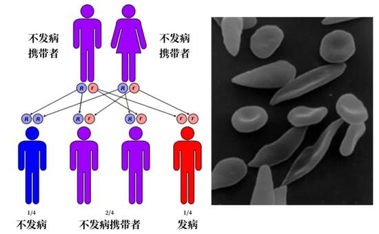 左：镰刀形红细胞贫血症的遗传机制简图，不发病携带者（Rr）较不容易感染疟疾。来源：Wikimedia Commons 右：电子显微镜下的镰刀形红细胞和正常红细胞。来源：Wikimedia Commons