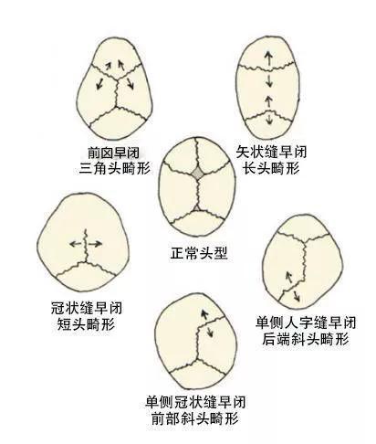 颅骨早闭导致的不同类型的头部畸形