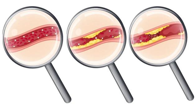 动脉硬化。| 图片来源:apollosugar.com