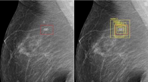 谷歌公司的研究人员已经成功训练出能够检测乳腺癌的人工智能，其准确率甚至比医生还高