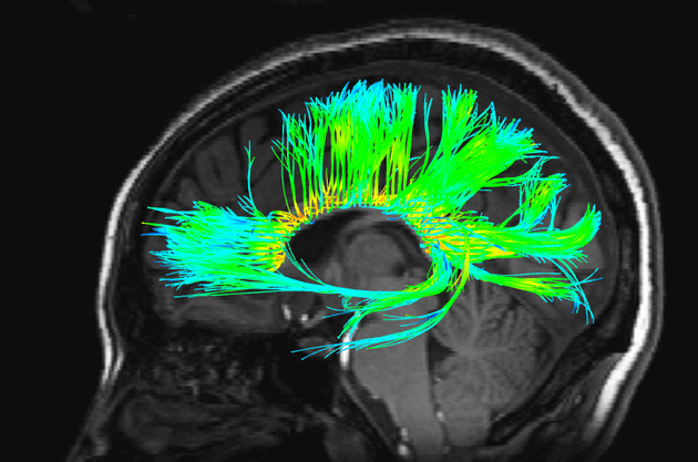 大脑的功能性核磁共振（fMRI）扫描图像
