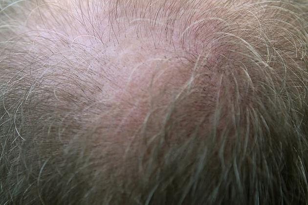 贝塞姆·法乔博士表示：“如果一名患者定期接受公司的治疗，那么我们将有望有效遏制秃顶的发生，并终生维持客户的正常发量。”
大约80%的男性和50%的女性会在一生中经历所谓“雄激素性脱发”，或者也叫“模型斑秃”，这种病症大部分情况下还可能会遗传。