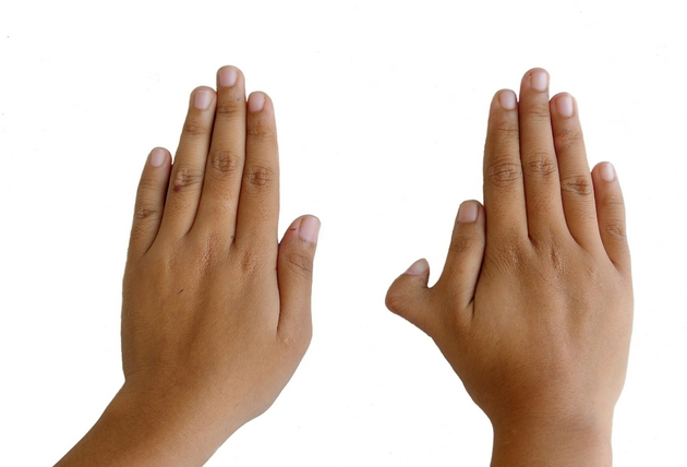 图1：图为正常五指与多指畸形的对比。右侧的手多长了一根大拇指。