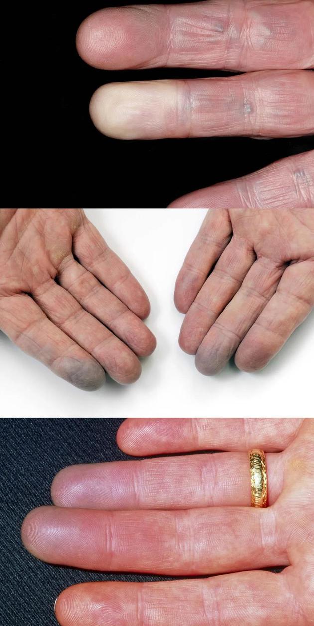 雷诺病的一些常见症状:由于血液流动受限,皮肤颜色可能会变白(上);有