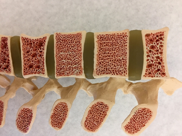 图中的脊椎模型展示了相对健康的骨头（组织较密集）和患骨质疏松的骨头（组织较松散）。
