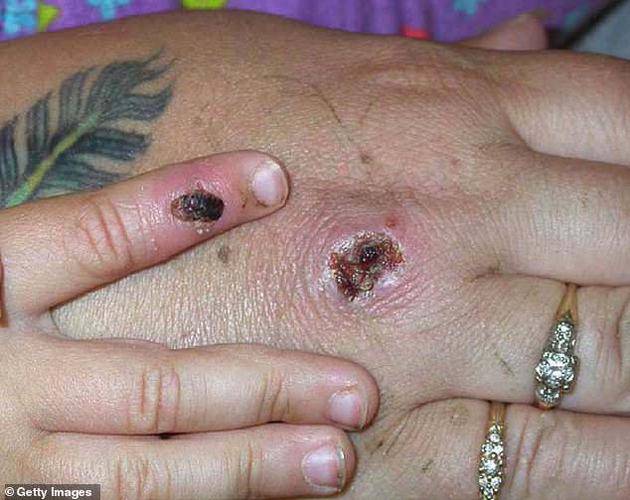 2003年出现第一例猴天花病毒案例，图中是患者的手。