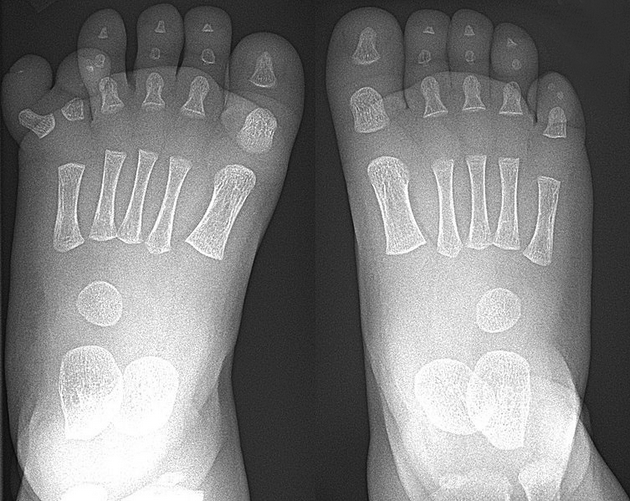 图3：图为长有六根脚趾的X光片。图中的第六根脚趾有独立、完整的骨骼结构，因此或许能提供一些行动上的优势。