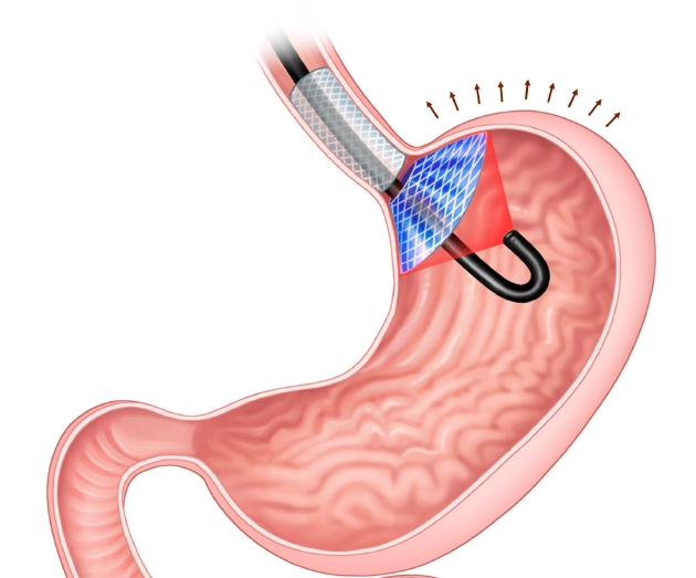 如图所示，图中蓝色和灰色部分是“胃内饱腹熏陶安设(ISD)”植入物，它通过按压胃部产生饱腹感，当该植入物涂层被激光激活时，就会杀死产生饥饿激素的细胞。