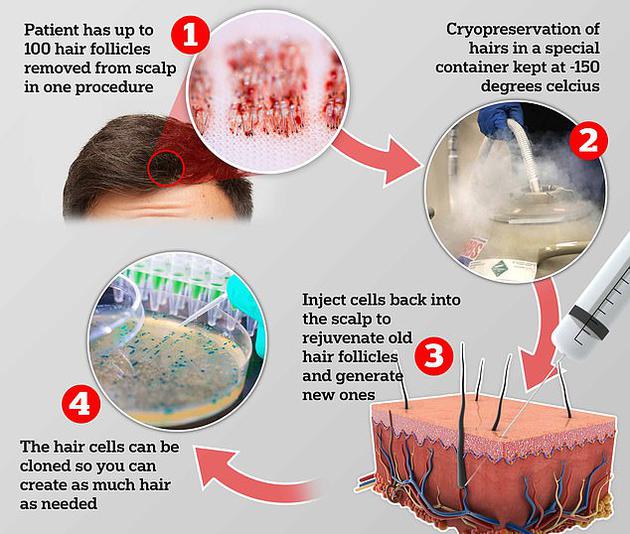 一家英国公司推出了应对脱发的一项服务：从你的头皮获取一定数量的毛囊并进行冷冻储存；当你未来发生脱发乃至秃顶时，公司将复制毛囊细胞并对你进行头皮注射，刺激毛发生长