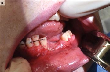 电子烟在17岁少年口中爆炸 牙被炸掉下颌骨折