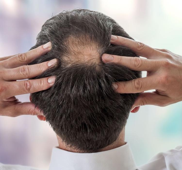 植发生意的难题：大多数人宁愿秃着