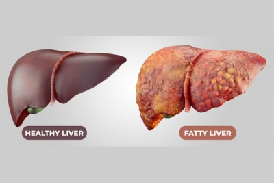 中国科学家找到营养不良人群患脂肪肝“祸首”
