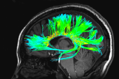机器学习新算法：一次脑扫描就能诊断阿尔茨海默病