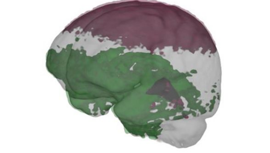 这是比利时安特卫普大学博士生史蒂文__尤灵斯对宇航员大脑结构的分析图。尤灵斯和同事发表研究报告称，他们的最新研究证实了之前关于太空飞行对大脑周围颅脊液分布的影响，大脑下部区域比上部区域被更多的脑脊液包裹着，这可能是航天飞行过程中导致大脑在颅骨内向上移动的一个迹象。