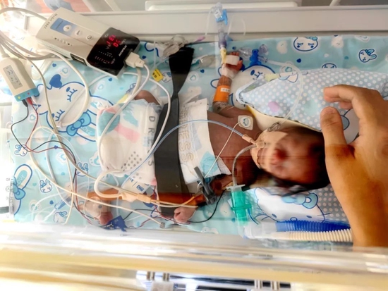 院间转运紧急手术丨体重不足三斤早产儿成功获救