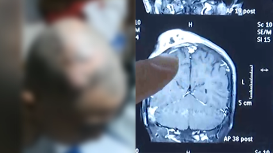 男孩理发被划伤5年后头上长大包 医生一看吓坏了