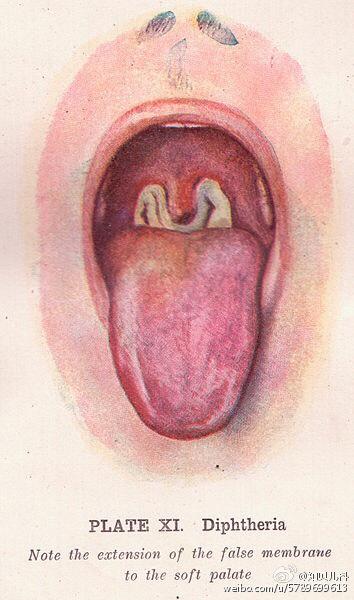 15,白喉是白喉杆菌引起的急性呼吸道传染病主要病变为咽喉部粘膜充血