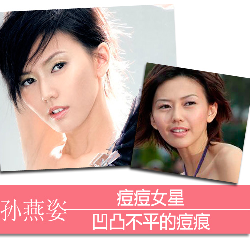 痘痘女星:孙燕姿