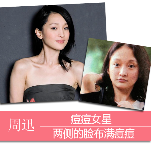 痘痘女星:周迅