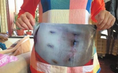 李女士手术后的腹部照片