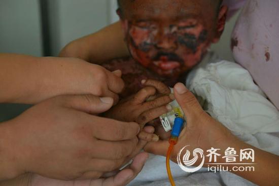 菏泽1岁男童患怪病 发烧致全身皮肤溃烂(图)