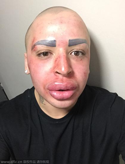 jordan最近的一次手术是争议极大的"僵尸美容"