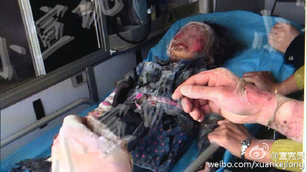 上海公园内烧烤用酒精父女俩遭严重烧伤图