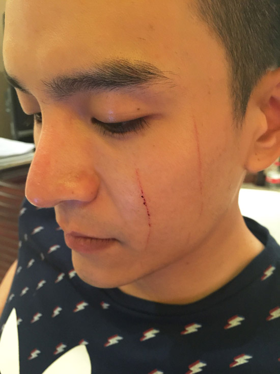 经超脸部10公分伤痕明显经超左脸遭划伤新浪娱乐讯 昨日,内地青年演员