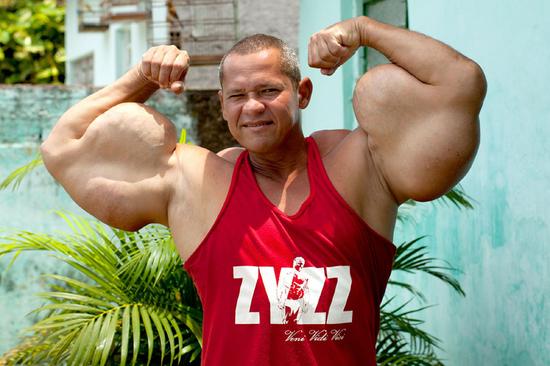 猛男注射燃料致肌肉膨胀变绿巨人险截肢