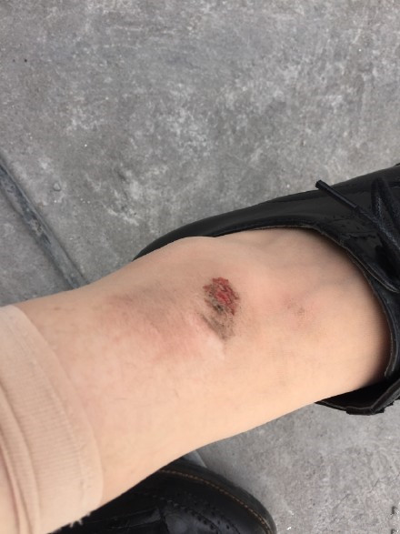 童蕾为躲炸点夺命飞奔不慎摔伤蹭破手掌