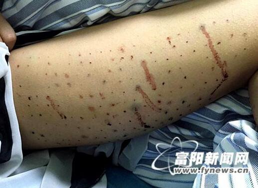 姑娘 腿上扎上百个窟窿减肥
