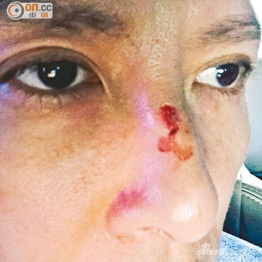 甄子丹前晚（6月8日）被劈伤鼻梁，在微博上载照片。