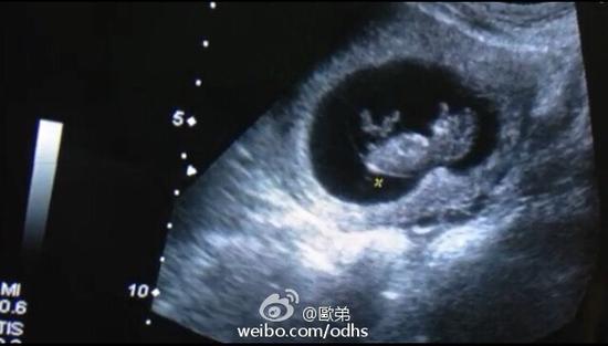 刚怀孕初期b超图 造假图片