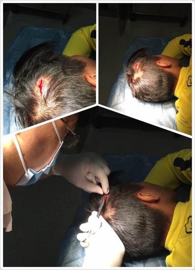 申鑫赛前看队员嘴部头部缝针图做动员 图慎入