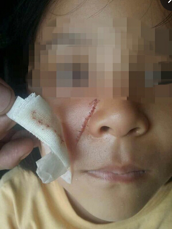 六岁女童幼儿园脸被划伤 伤口长达数厘米