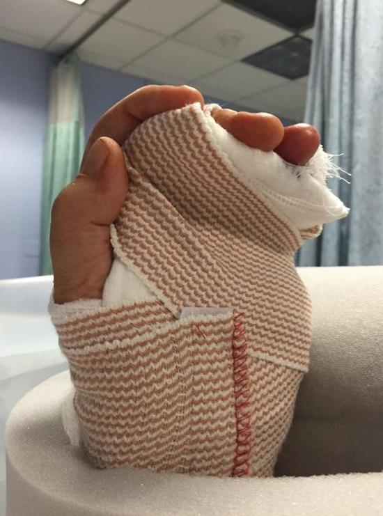 他自拍的手指受伤后的惨状