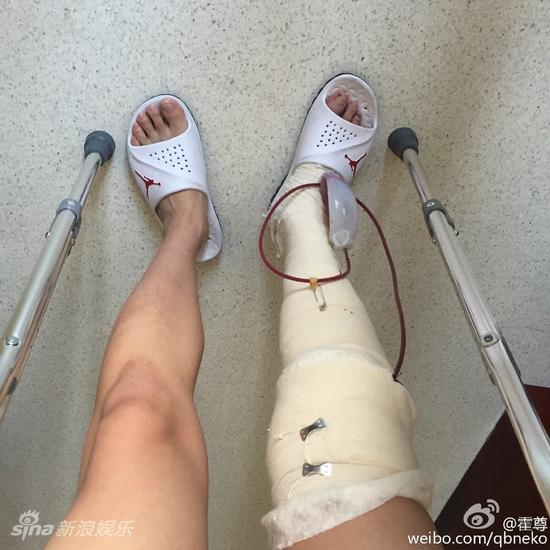 霍尊手术后脸色憔悴拄双拐仍不忘剪刀手