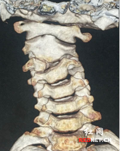 讯(通讯员 胡喻)作为国内首次报道,全球第四例报道的罕见颈椎畸形案例