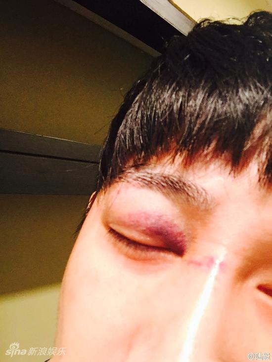 陆毅拍戏眼部受伤寻消肿法伤口不忍直视