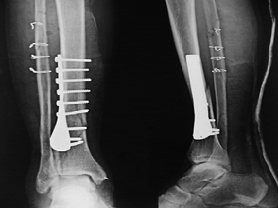 胫腓骨骨折X光图（资料图，与卢克-肖无关）