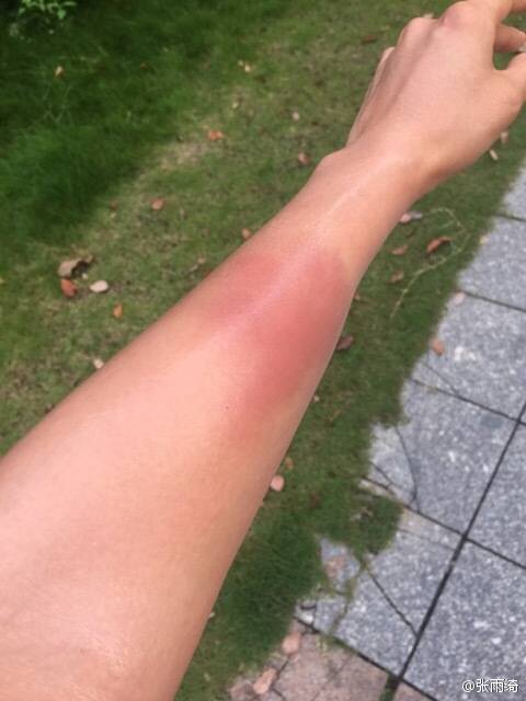 张雨绮推飞机至小臂红肿