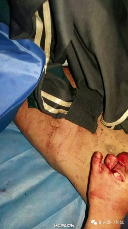 6岁男童身中十几刀生殖器官被砍断图