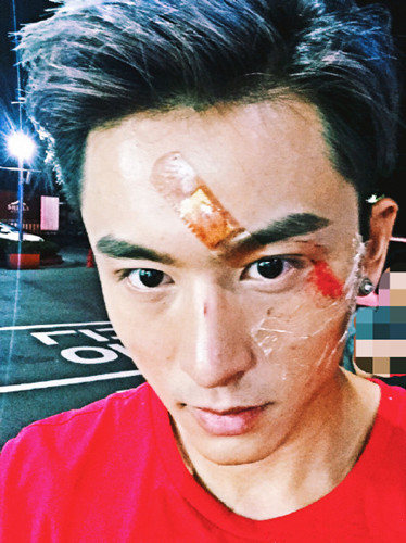 张哲瀚意外受伤