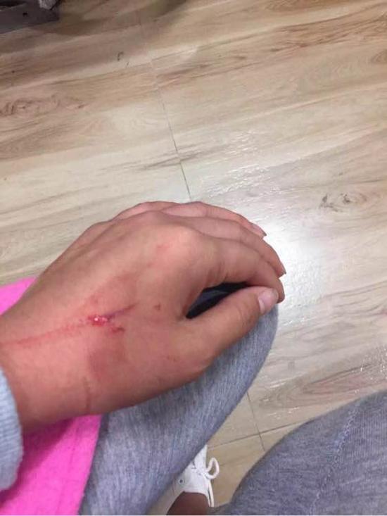 　　陈女士手上的伤 图来自网友默念a09