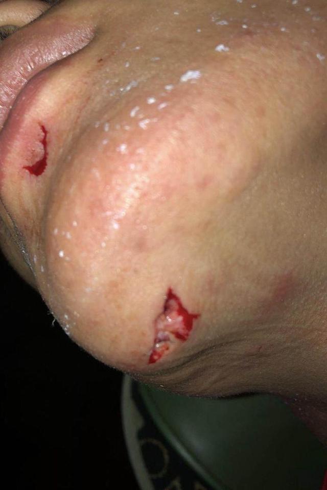 林良铭比赛中遭暴力犯规 下颌缝13针|图