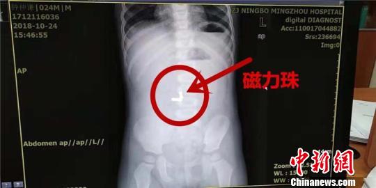 在X光片下，一颗颗珠子清晰可见。浙江大学明州医院供图